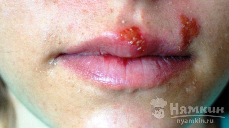 Простуда на губах: чем лечить высыпания